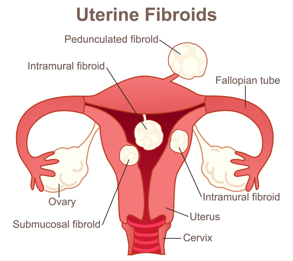 uterine fibroids treatment Arizona